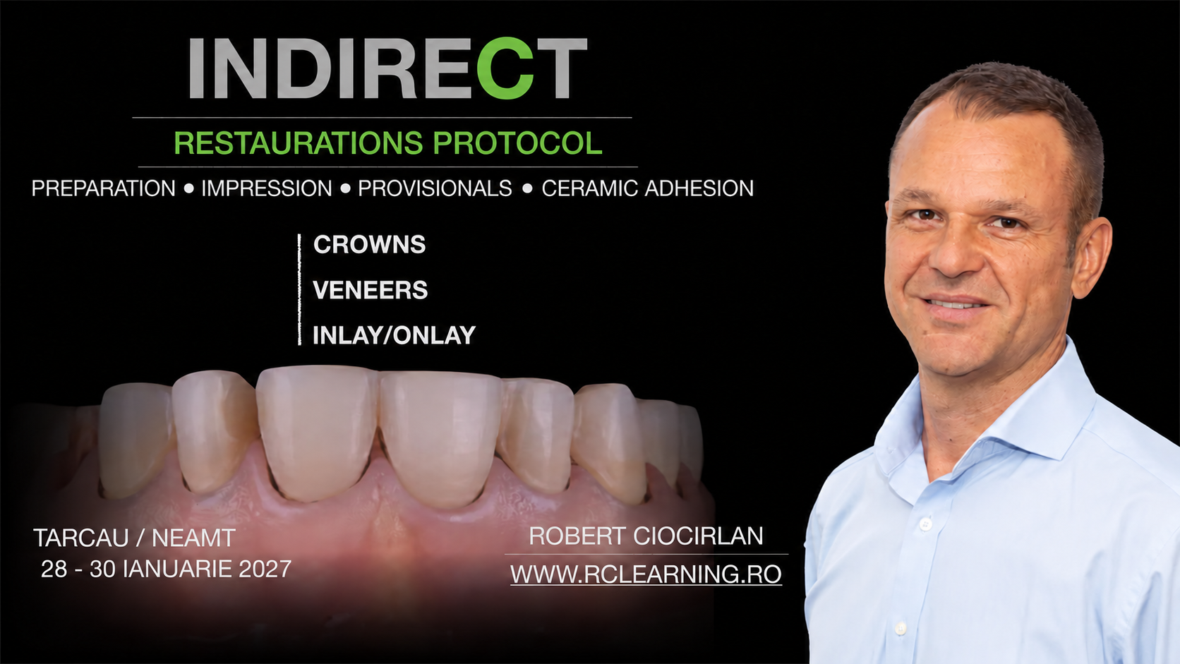 Indirect Restorations Protocol