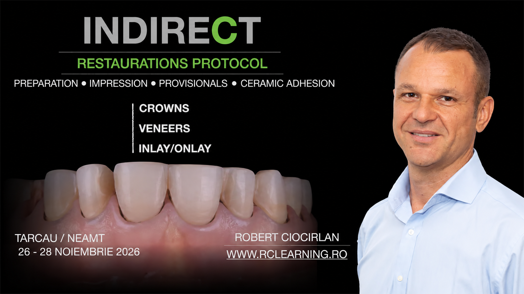 Indirect Restorations Protocol 