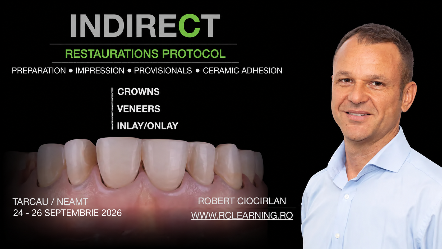 Indirect Restorations Protocol 